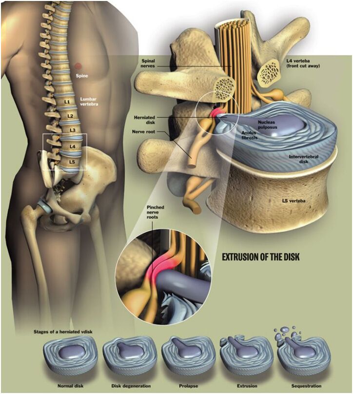 Non-Surgical Spinal Decompression Therapy - Irvine Spine & Sport